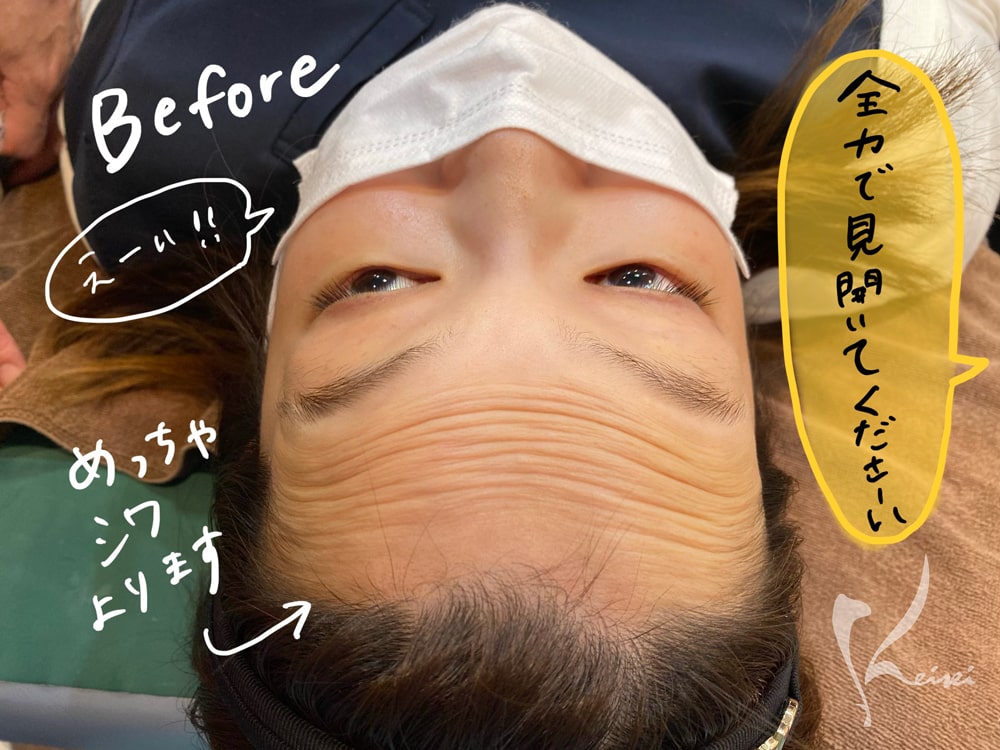 赤松さんヒアルロン酸注入前に全力で目を見開き、額に多くのシワが出来ていることを示す写真