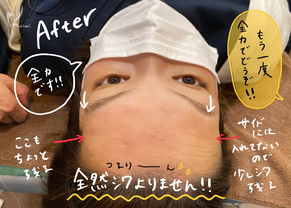 赤松さんヒアルロン酸注入後に、全力で目を見開いても額にシワが出来なくなっていることを示す写真