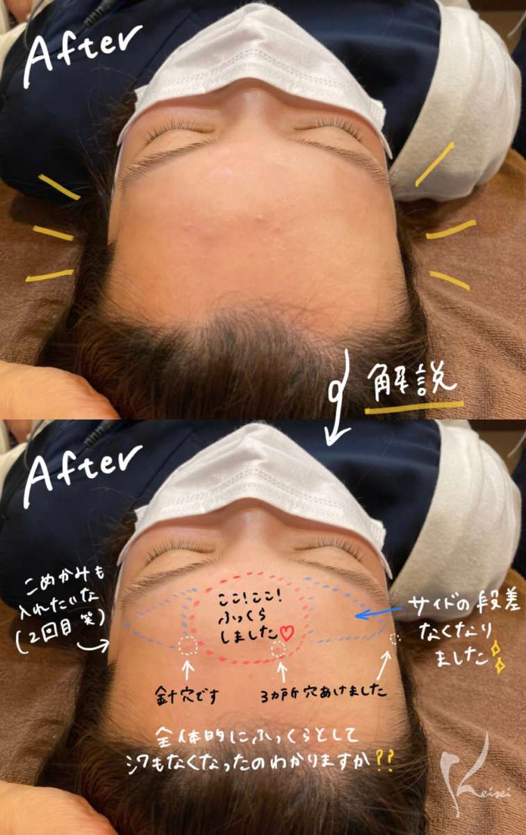 赤松さんヒアルロン酸注入前後の写真
