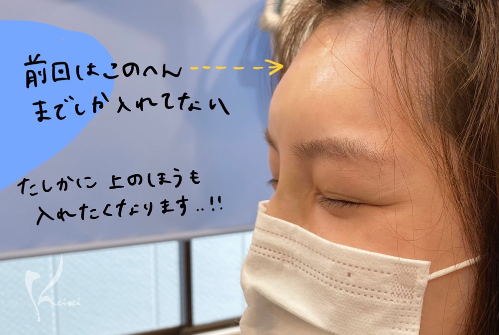 赤松さん1回目のヒアルロン酸注入後の額の段差を示す写真