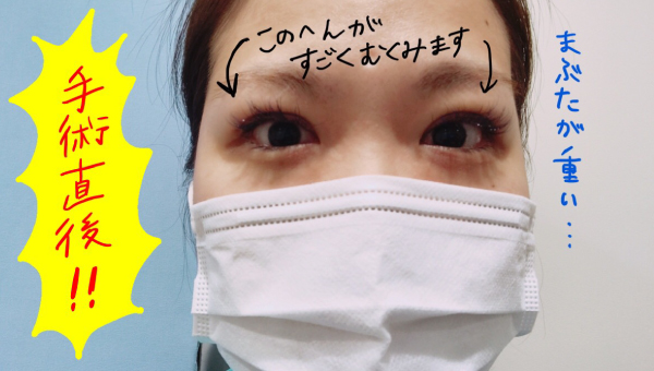 二重 埋没法 術後 腫れる