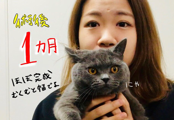 恵聖会クリニック 松本医師 二重埋没法 1ヶ月 完成