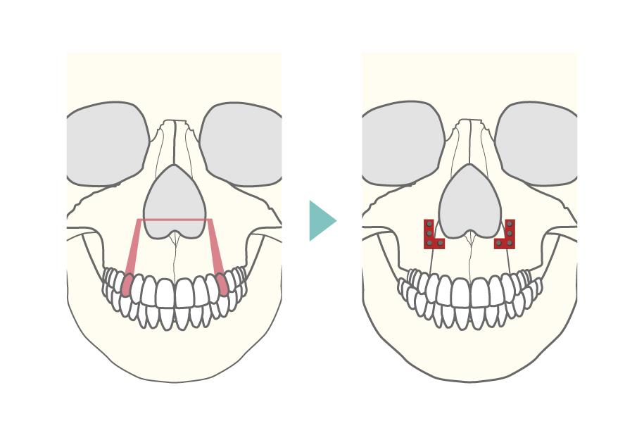 上顎分節骨切り術式の正面からのイメージ