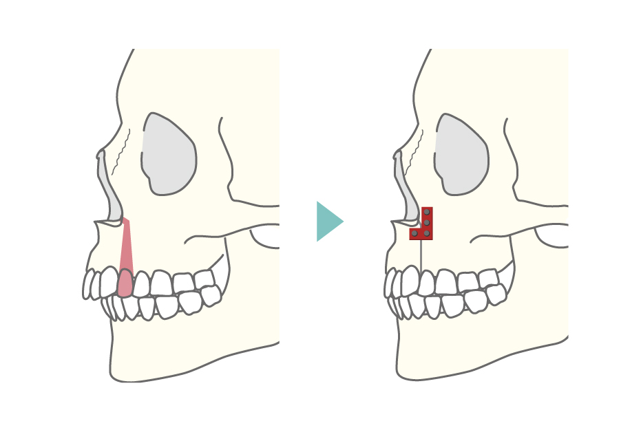 上顎分節骨切り術式の横からのイメージ