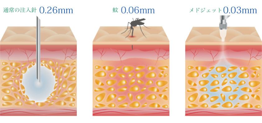 botox ボトックス ボツリヌス アラガン ビスタ しわ エイジングケア アンチエイジング 多汗症 メドジェット蚊の針より細い