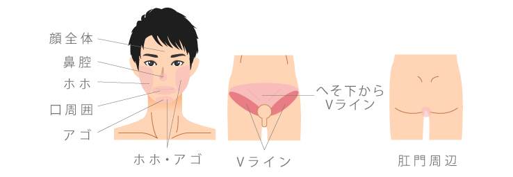 医療レーザー 脱毛 エステ 永久脱毛 レーザー脱毛 ダイオード ソプラノ ジェントル