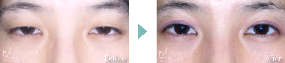 二重整形 マイクロ切開 ミニ切開 症例 大阪