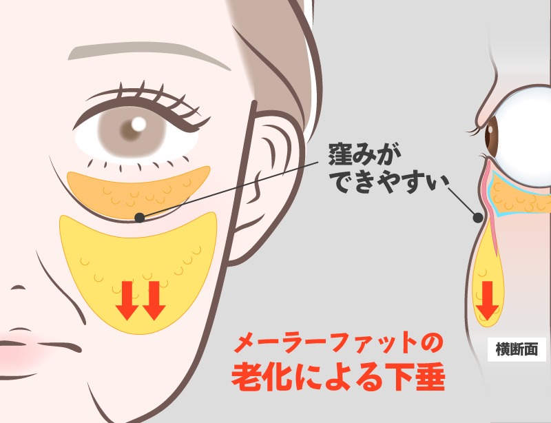 メーラーファットが下垂　解説図