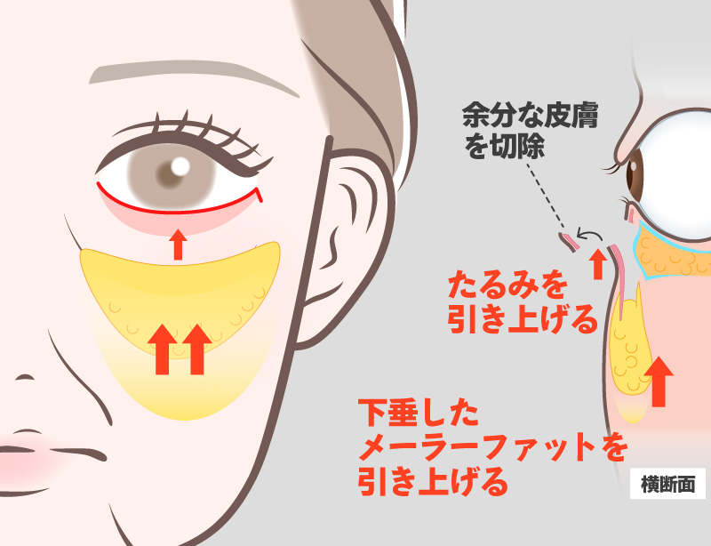ミッドフェイスリフト術式イメージ2
