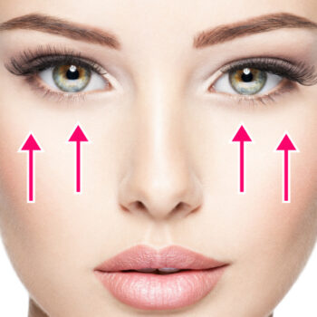 ミッドフェイスリフト（頬のたるみ矯正）