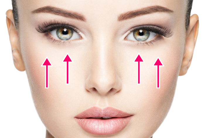 ミッドフェイスリフト（頬のたるみ矯正）