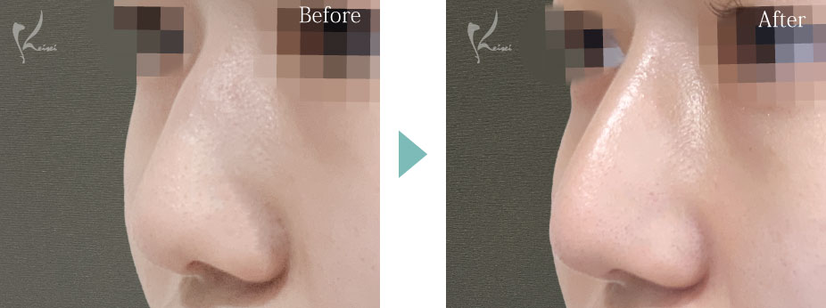 鼻骨骨切り術　鷲鼻修正（hump切除）+隆鼻術（プロテーゼ）+鼻尖形成 