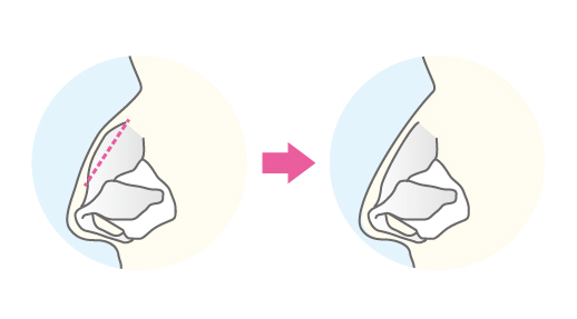 鼻骨骨切り術（鷲鼻修正）の術式