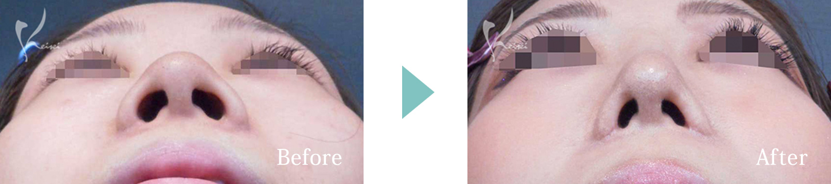隆鼻術（プロテーゼ）＋鼻尖形成＋小鼻縮小＋鼻中隔延長の症例写真