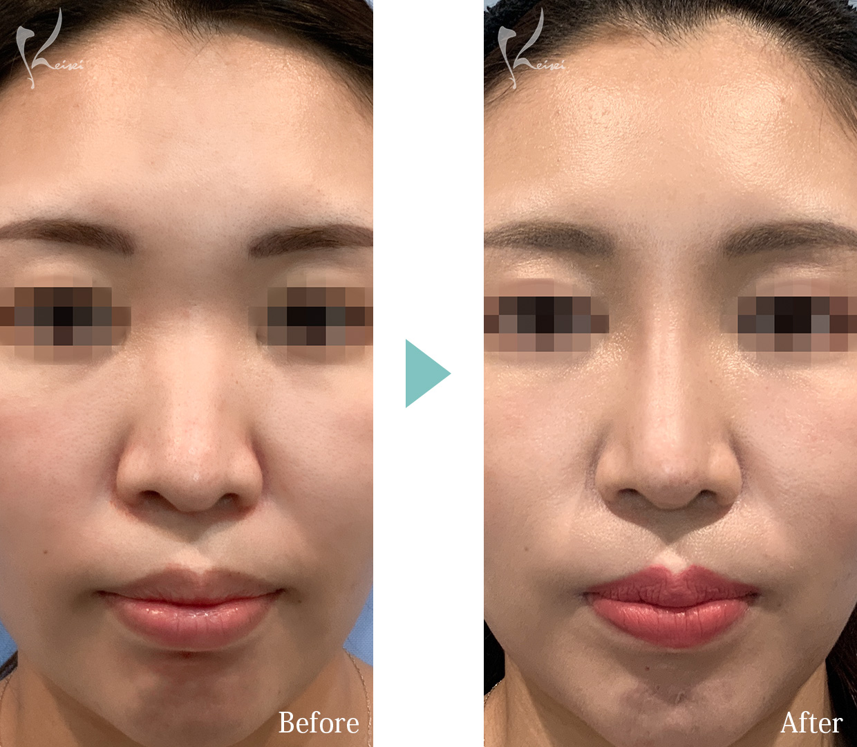 隆鼻術（プロテーゼ）＋鼻尖形成＋鼻中隔延長（耳介軟骨移植）の正面の症例写真