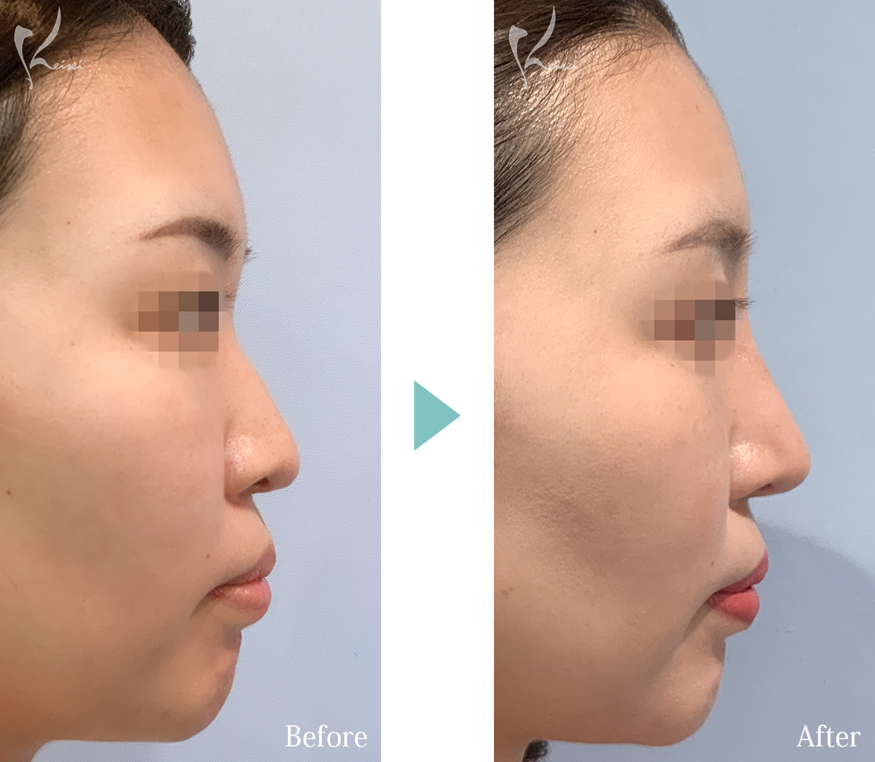 隆鼻術（プロテーゼ）＋鼻尖形成＋鼻中隔延長（耳介軟骨移植）の下からの症例写真