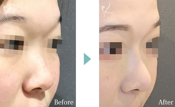 隆鼻術（プロテーゼ）＋鼻尖形成＋鼻中隔延長（耳介軟骨移植）の症例写真