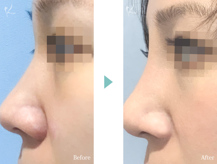 隆鼻術（プロテーゼ）＋鼻尖形成＋小鼻縮小の症例写真