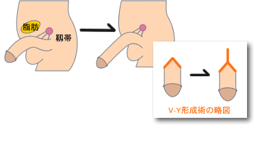 長茎 男性器 大阪 泌尿器形成