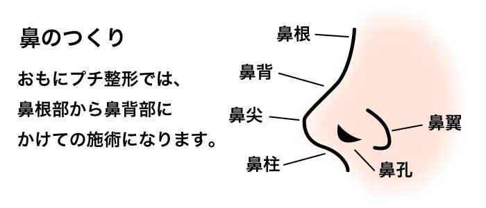 隆鼻術(プロテーゼ)