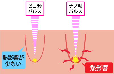 ピコレーザー タトゥー除去 入れ墨除去 刺青除去 カラータトゥー除去 あざ治療 ピコ秒