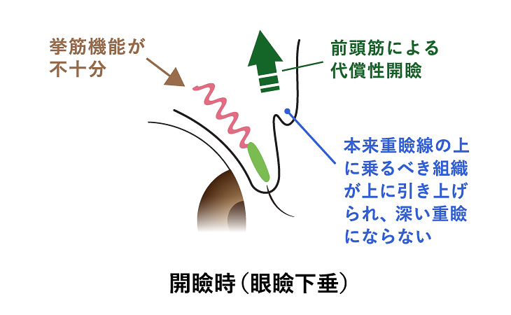 眼瞼下垂の目を開いた状態のイラスト画像