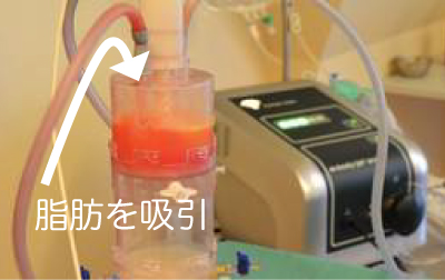 脂肪を吸引（写真）