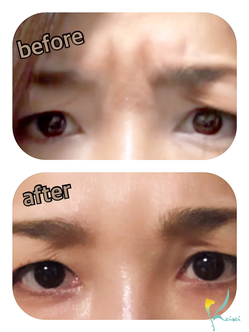 眉間のヒアルロン酸注入の施術前後の画像