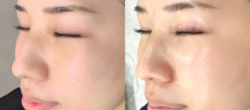 ダーマシューティック ミルクピールトリートメント DERMACEUTIC