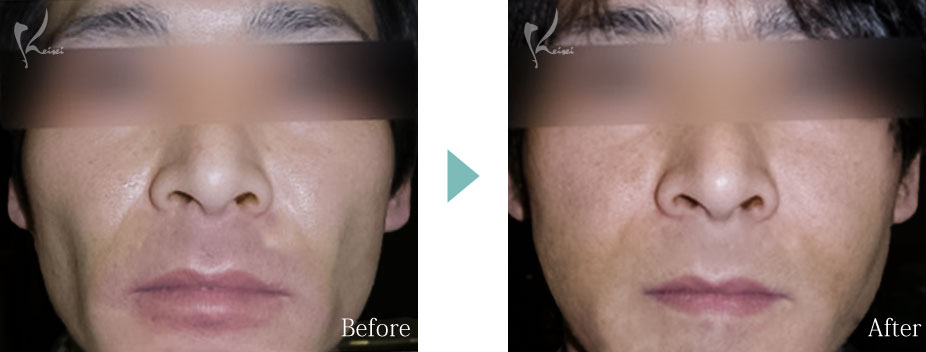 ホホ こめかみ へこみ くぼみ 脂肪注入 大阪 フェイスライン 症例