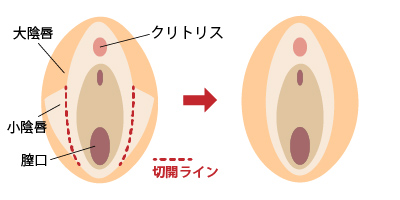 しょう いん しん 縮小 手術 保険 適用