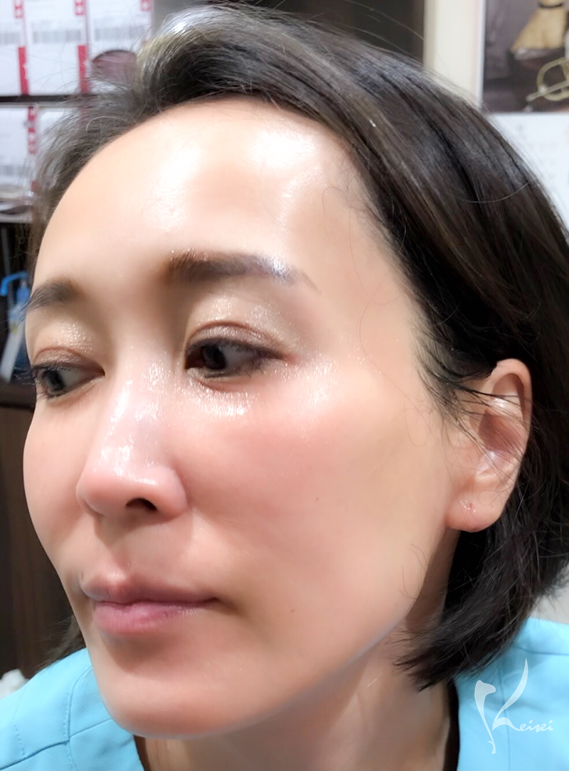 コラジェナイザープレミアムの施術後のお肌の状態