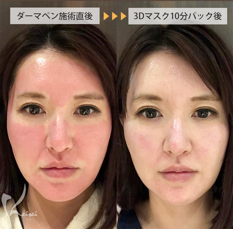 ダーマペン後の赤みのある顔と3Dマスクを10分パックした顔の比較