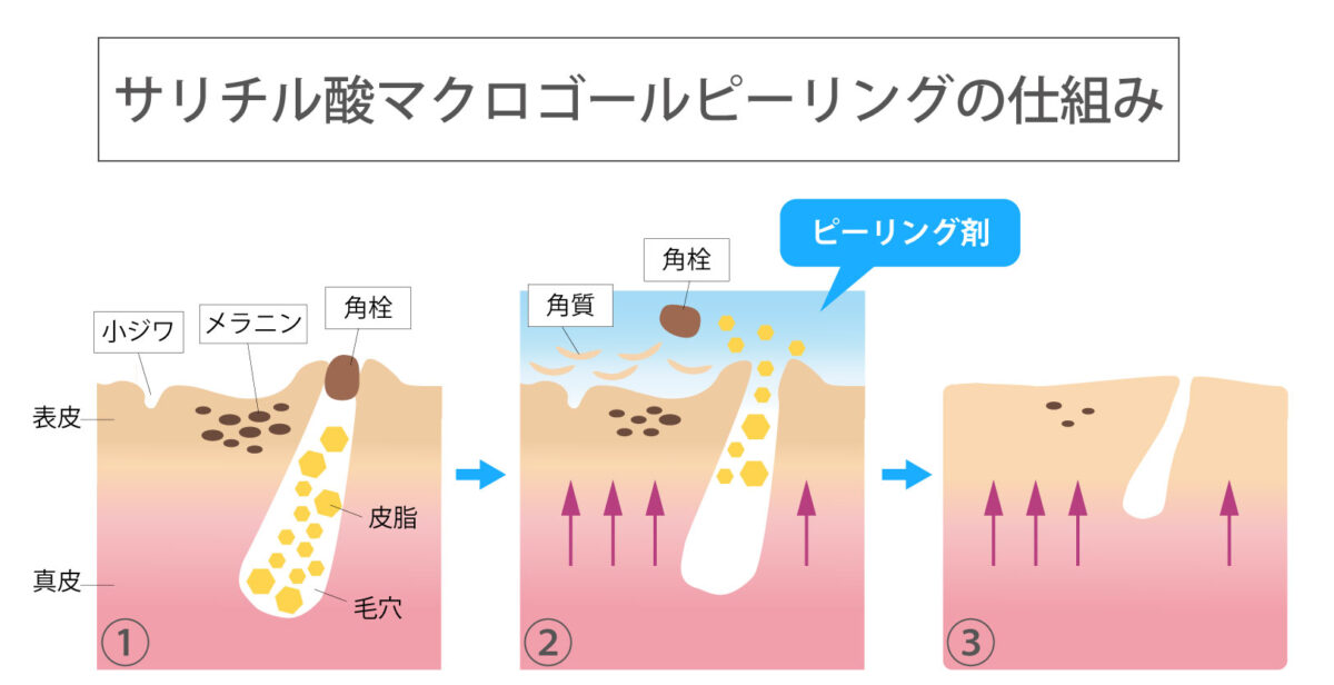 サリチル酸マクロゴールピーリングの仕組み