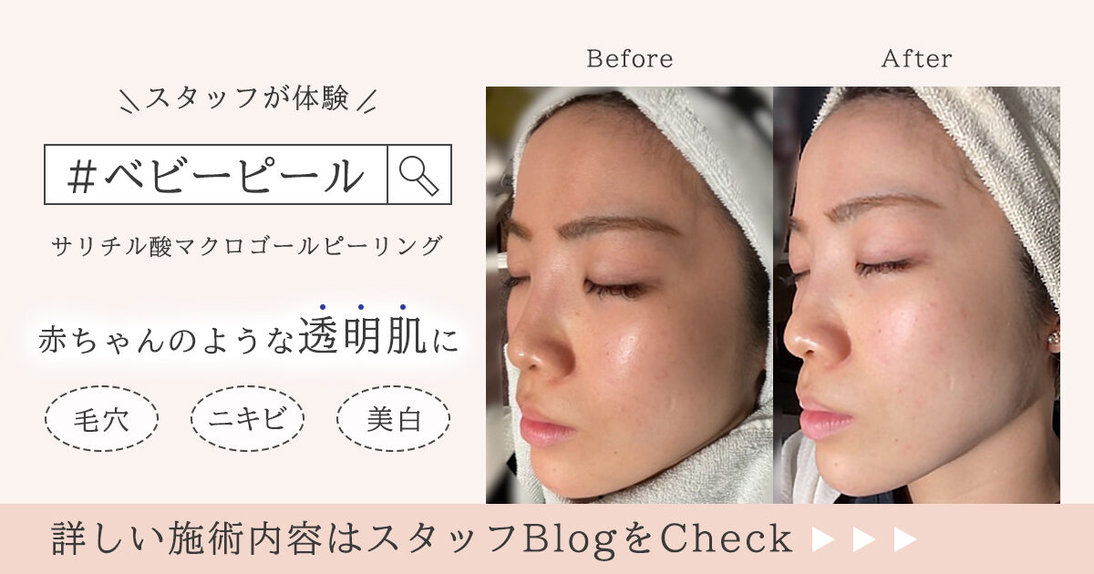 脱！マスクニキビ～サリチル酸マクロゴールピーリング～｜恵聖会