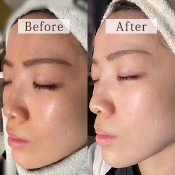 脱！マスクニキビ～サリチル酸マクロゴールピーリング～｜恵聖会