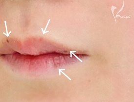 口唇メラノーシスの写真