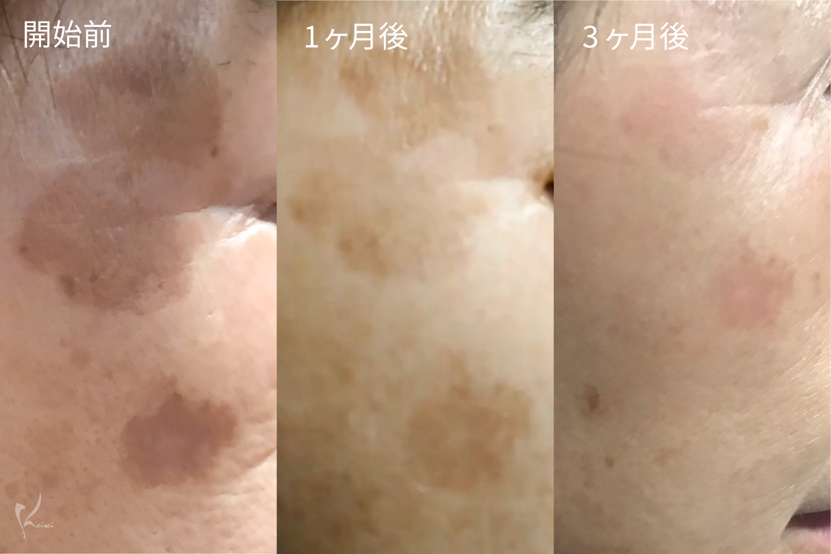 セラピューティックを使った変化過程