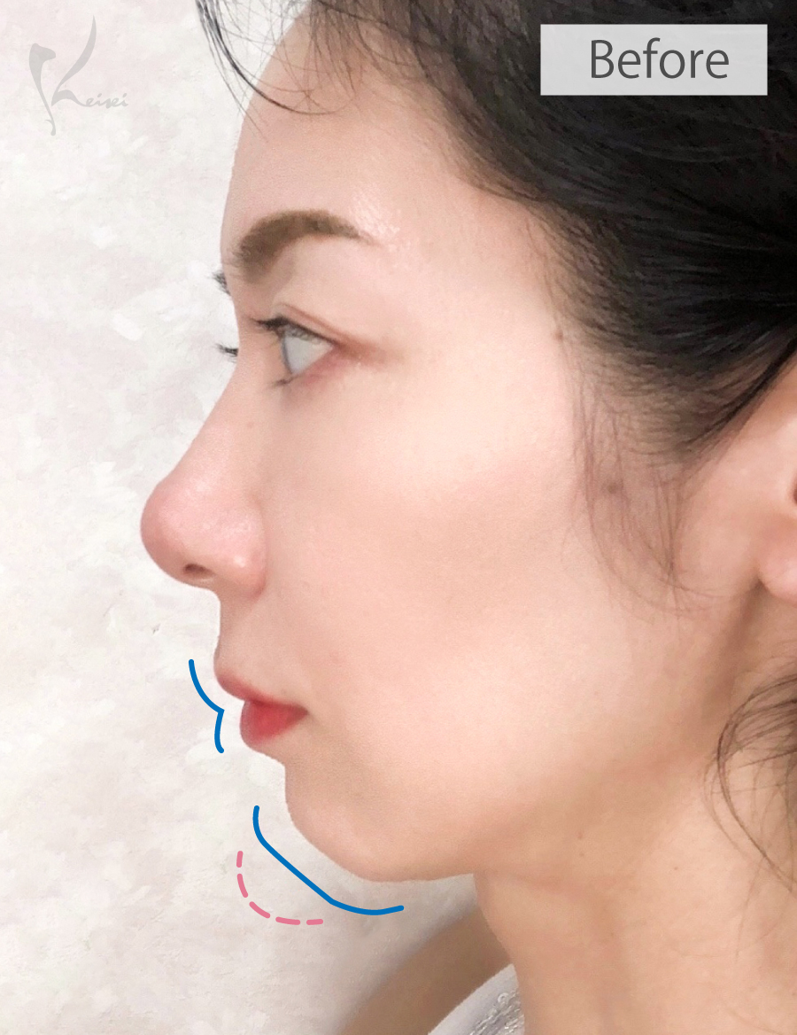 唇とアゴのヒアルロン酸による横からの施術前の症例写真