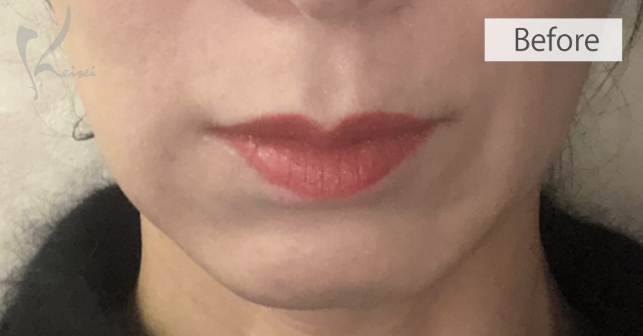 唇とアゴのヒアルロン酸による正面からの施術前の症例写真