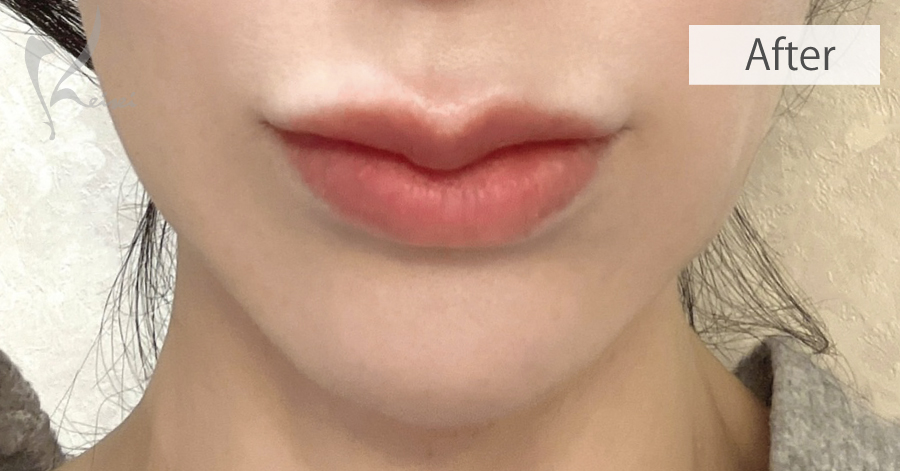 唇とアゴのヒアルロン酸による正面からの施術後の症例写真
