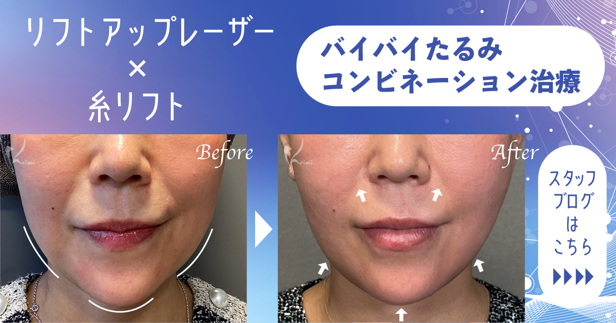 バイバイたるみ リフトアップレーザー×糸リフトのコンビネーション治療