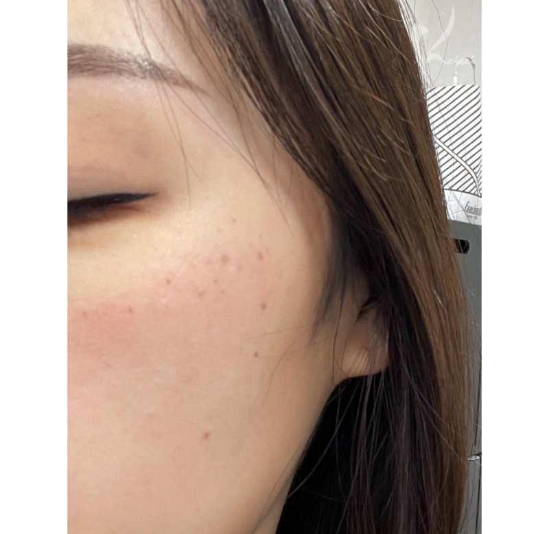 施術直後の写真