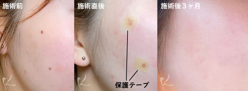 施術後の写真