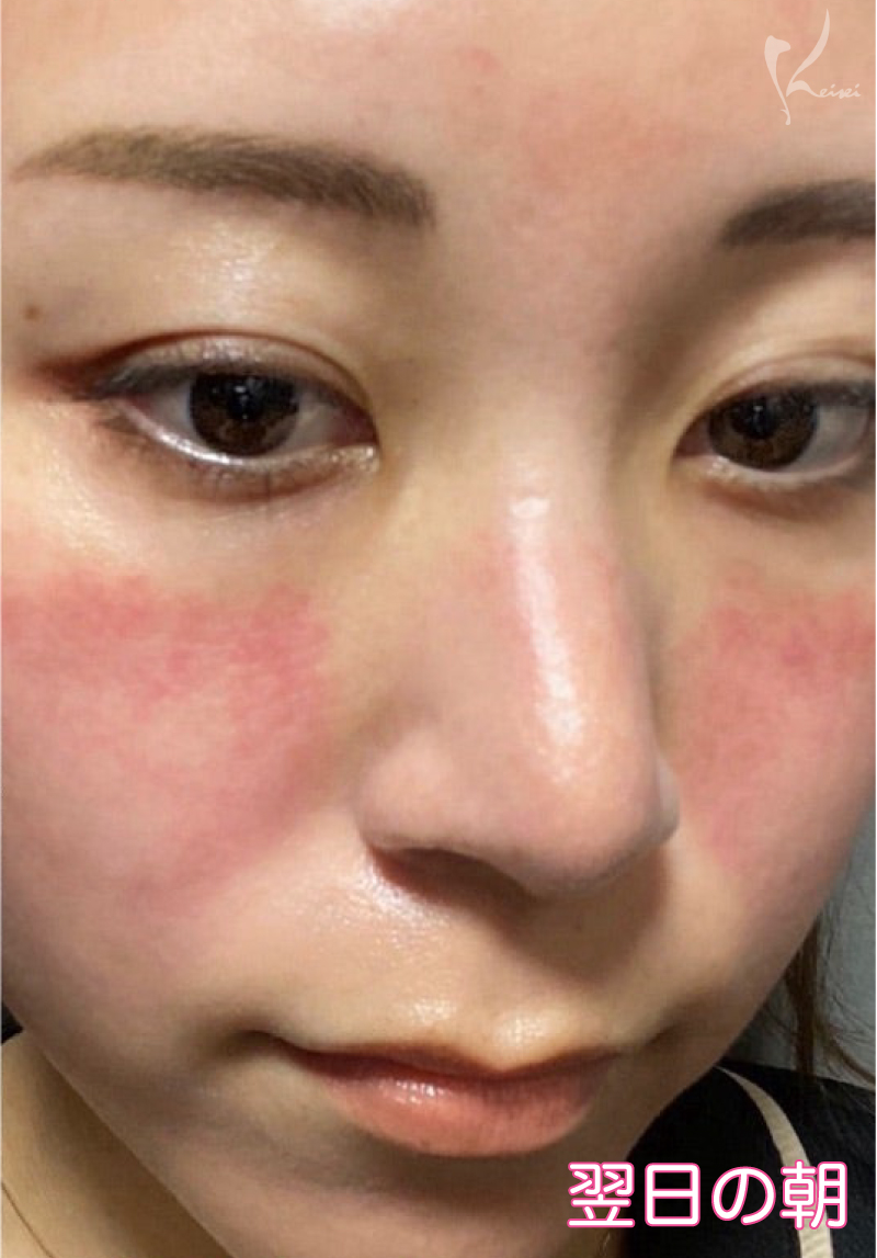 ダーマペン4翌日の様子