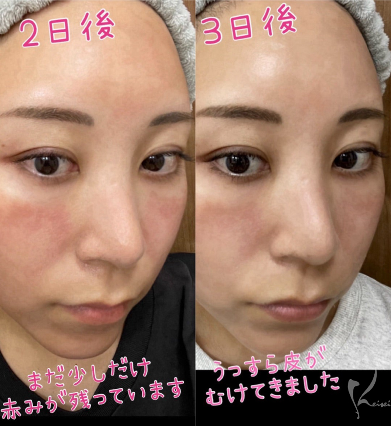 ダーマペン2日後・3日後の様子