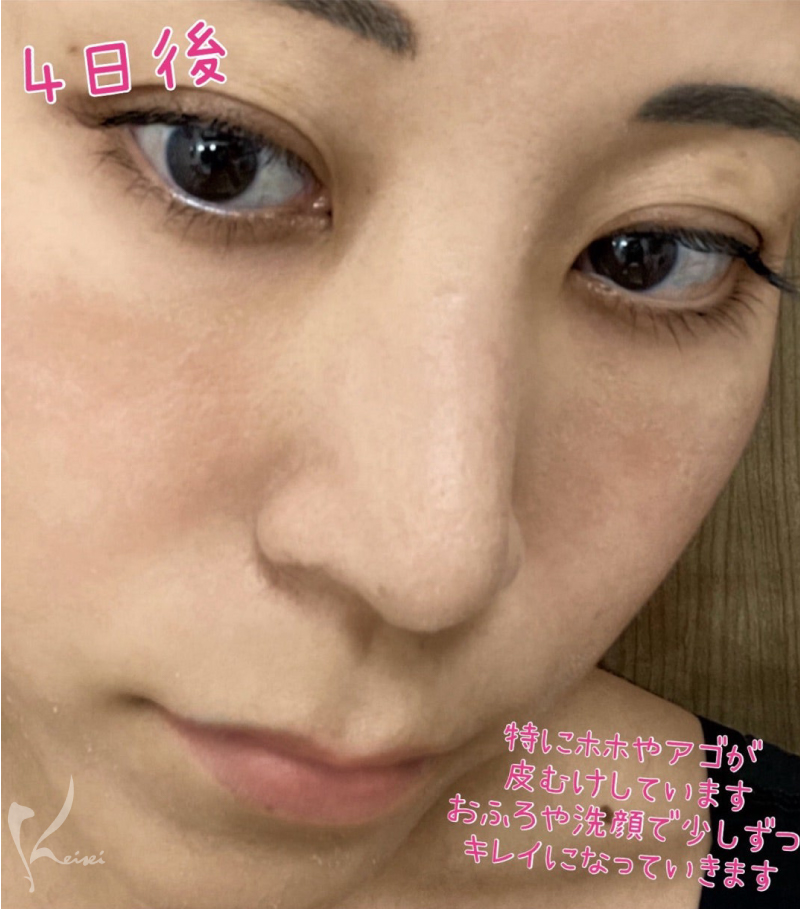 ダーマペン4、4日後の様子