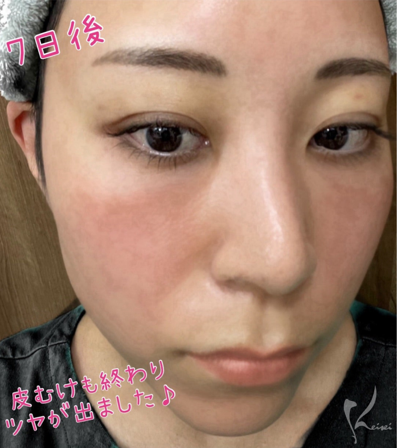 ダーマペン4、7日後の様子