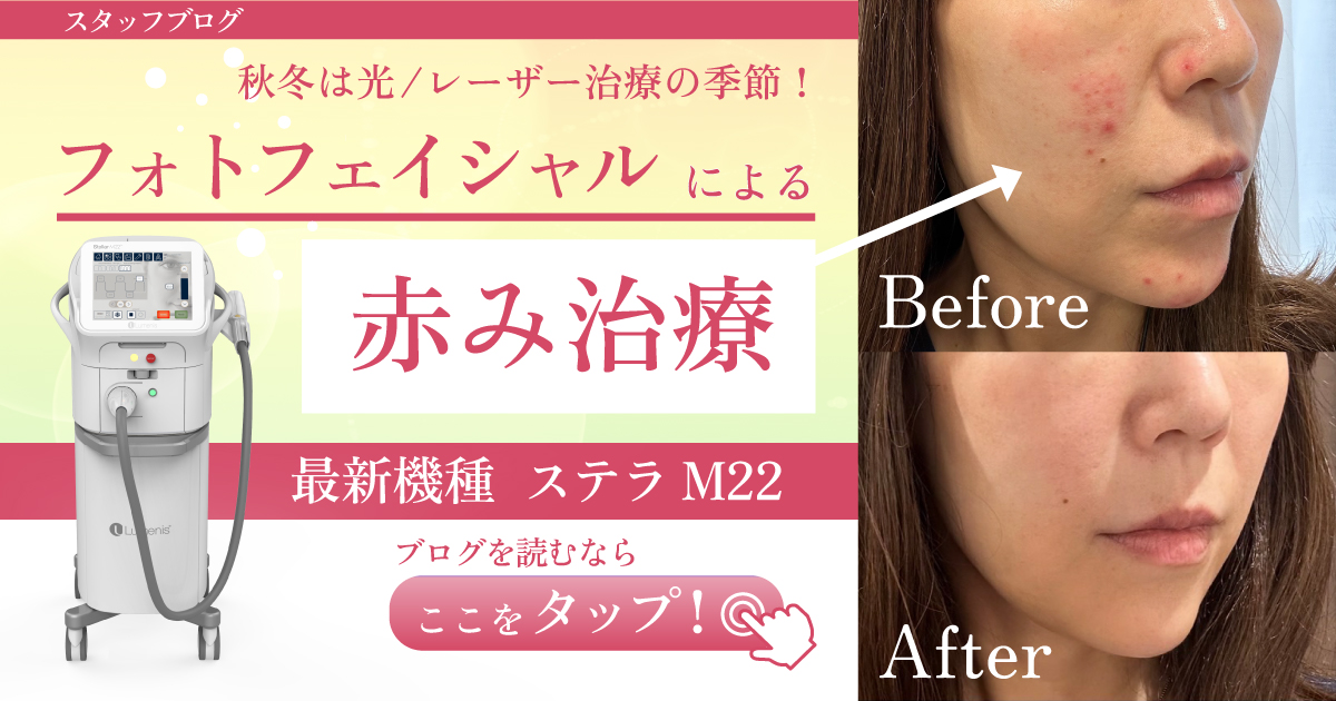 ✨️最安値新品低周波顔シミ取りエステ✨️赤字覚悟！ ✨️最安値新品低周波顔シミ取りエステ✨️赤字覚悟！ ✨️最安値