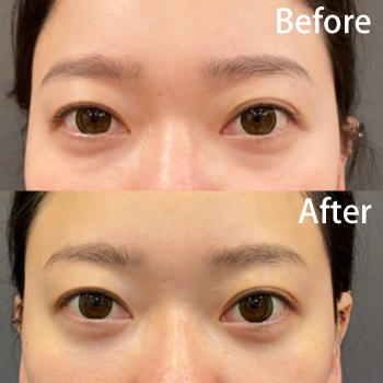 目の下脱脂で、クマ取りました。サムネイル